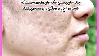 درمان چاله های صورت با طب سنتی تزریق بوتاکس