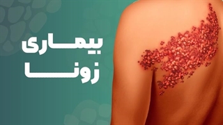 مهم ترین نکات در مورد بیماری زونا