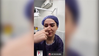 Eyebrow transplantation, tailored to the frame of your eyes