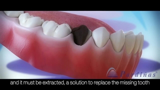 ایمپلنت فوری دندان؛ راه‌حلی سریع برای جایگزینی دندان کشیده‌شده